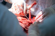Abdominal plastic operation in hospital. Closeup surgeon in sterile gloves make tummy tuck surgery