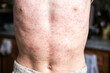© Наталья Майшева - A person's body is covered in a rash, measles.