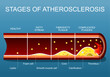 Stages of atherosclerosis. Close-up of an Arterial wall
