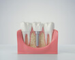 Dental Implant, white tooth model 3d illustration.