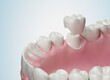 Dental crown, teeth installation isolate on white background, 3d illustration.
