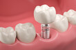 Closeup white tooth and gum with Dental implant , Human Teeth for Medical Concept, 3d illustration.
