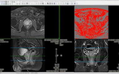 Wall Mural - MRI of the prostate gland, revealing an enlarged size.