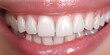 Bright White Teeth: A Close-Up of Dental Veneers. Concept Dental Veneers, Dental Procedure, Cosmetic Dentistry, Bright Smile, Close-Up Portrait