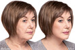Portrait of an elderly woman before and after skin tightening and cosmetic procedures.