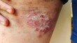 © Rung Kh - close up of a patient, showing the rash hives allergy and inflammation skin, reaction and urticaria on the leg of the woman, health care and medical concept.