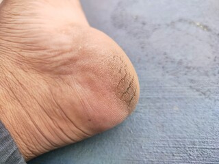 close up of cracks on heels. person with dry skin on heel