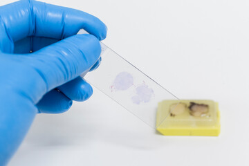 Wall Mural - Scientist wear blue glove holding slide and out of focus paraffin human tissue block on white background.Doctor is examining histological sample, a biopsy in the laboratory of cancer research.