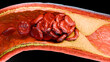© MohammedElAmine - Cholesterrol or Atherosclerotic Plaque in blood vessels, Blocked vessel stroke, Thickened Arteries and Veins, Coronary, fat buildup clogging, Atherosclerosis or atheromatous Hyperlipidemia, 3d render