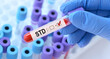 © syhin_stas - Doctor holding a test blood sample tube with sexually transmitted diseases (STD) test on the background of medical test tubes with analyzes.