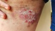 © Rung Kh - close up of a patient, holding the rash hives allergy and inflammation skin, reaction and urticaria on the leg, health care and medical concept.