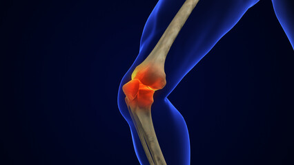 Wall Mural - Anatomy Human Knee Joint Treatment, Osteoarthritis Injection