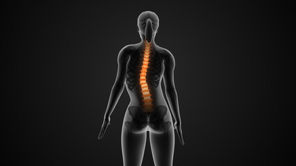 Wall Mural - The medical condition of scoliosis of the spine