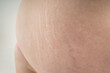© staras - Flabby skin with stretch marks on a fat belly, plastic surgery concept