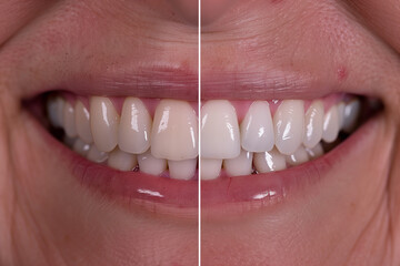 Two different sets of teeth, one with a white filling and the other with a white crown