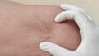 © Rung Kh - close up of an injection, stress and serious, problem circulation of blood, varicose veins on the leg of the middle aged women, health care and medical concept.