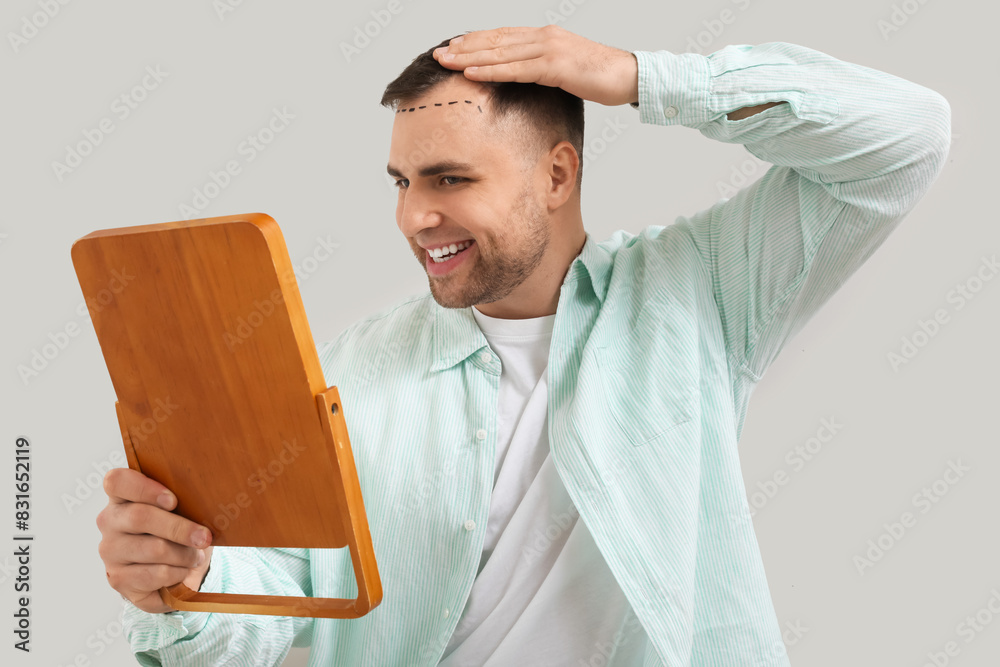 Happy young man with hair loss problem and marks on his forehead looking in mirror against light background