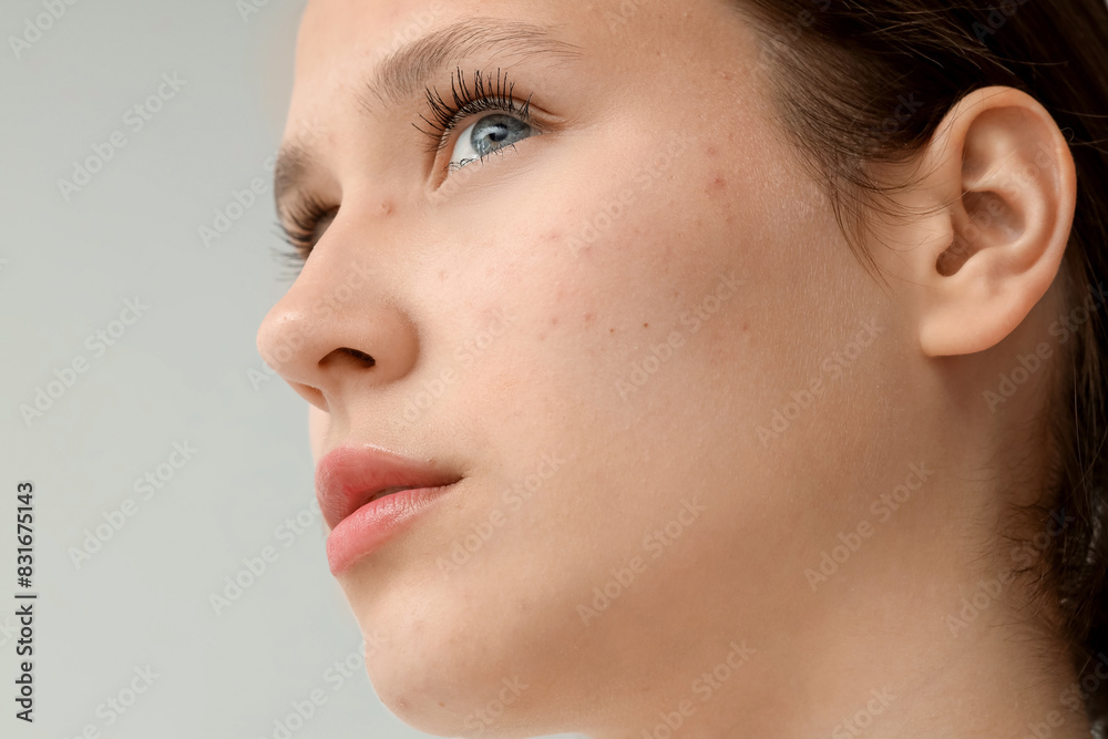 Beautiful young woman with acne problem on grey background, closeup
