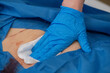 © Image Source - A close-up image of a medical professional's hand in a blue glove, cleaning a patient's skin with a white cloth near a surgical site covered with a blue drape.