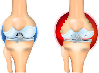 rheumatoid arthritis of knee joint