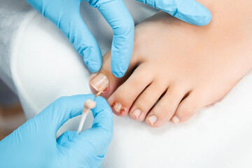 Wall Mural - Close up podiatrist examines the nail and applies an antifungal treatment. 