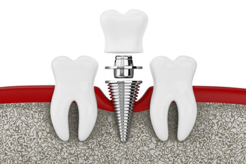 Poster - Dental Tooth Implant Installation and Crown Placement. 3d Rendering