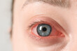 © New Africa - Woman with red eye suffering from conjunctivitis on light background, closeup