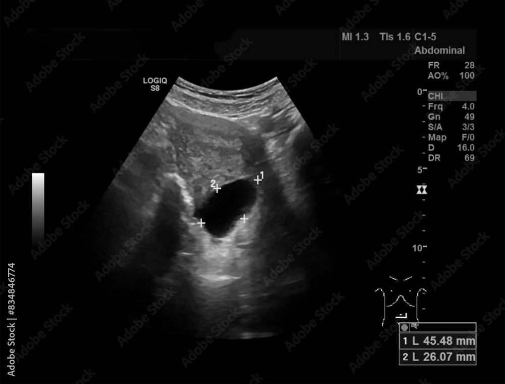 Abdominal Ultrasound Image with Detailed Organ Structures, Perfect for ...
