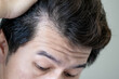 © Summer Paradive - Hair loss or alopecia problem. Receding hairline. Closeup head of Asian man while raising up his black damaged hair showing bald head area and forehead creases wrinkle