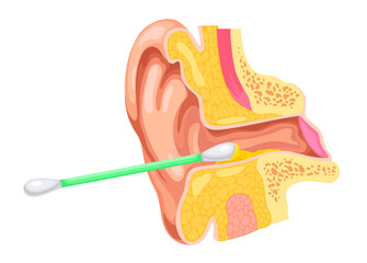 Ear canal cleaning. Ears clean earwax inside with cotton swab, otorhinolaryngology concept earing canal closeup anatomy dirty wax cerumen problem, ingenious vector illustration