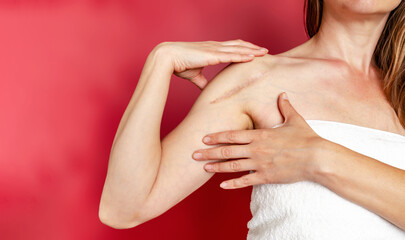 Wall Mural - Postoperative scar on woman shoulder. A woman shows the scar. Scar after surgery after a broken arm bone. Photo on a red background.