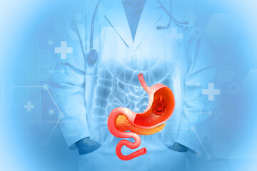 Wall Mural - Stomach cancer, gastric cancer, symptoms, stages, treatment, 3d illustration.