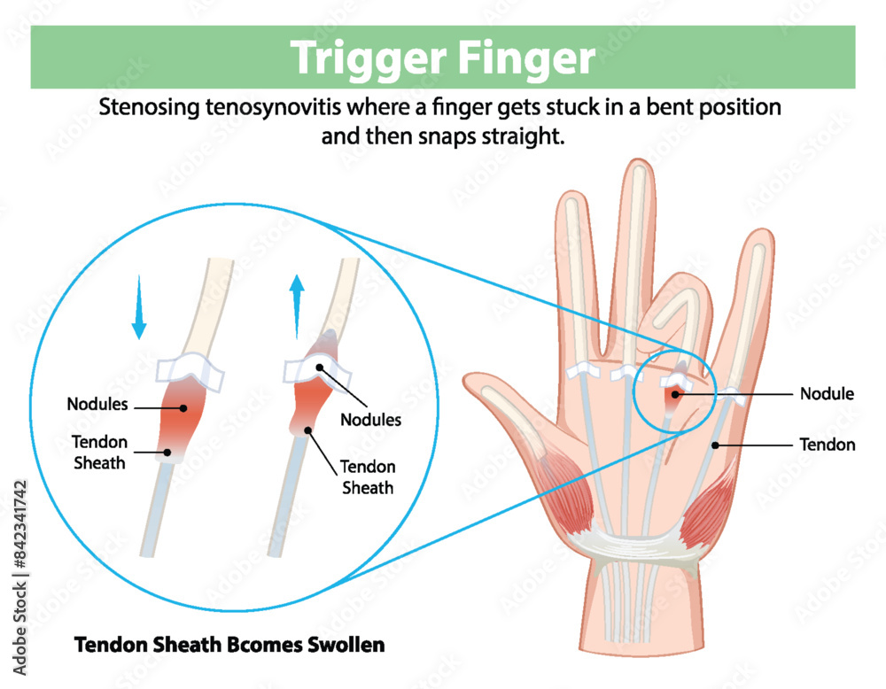 Diagram explaining trigger finger condition and symptoms