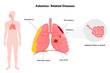 © Oksana - Asbestos-related diseases lungs problem