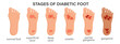 © Tatiana - Stages of diabetic foot syndrome. Deep ulcer, open wound on the foot. Diabetic foot or diabetes, gangrene, necrosis, neuropathy, necrotizing fasciitis. Medical infographics banner