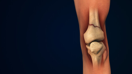 Leg bone Fracture or inflammation of human knee joint