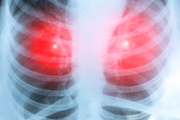 Fluorography, x-ray scan. Medical treatment concept. Diagnosis of the disease humans lungs.