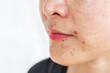 © boyloso - Cropped shot view of Asian woman having skin problem such as acne, scar, wrinkled occur on her face.