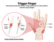 © GraphicsRF - Diagram explaining trigger finger condition and symptoms