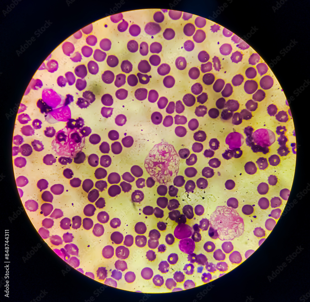 Chronic myeloid leukemia cells or CML, analyze by microscope. Blood ...