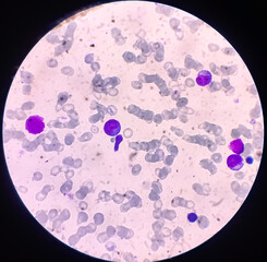 Sticker - Bone marrow study(BMS): Lymphocytosis with clumped chromatin. Pancytopenia in PBF. Lymphoproliferative disorders. Lymphoproliferative disease.