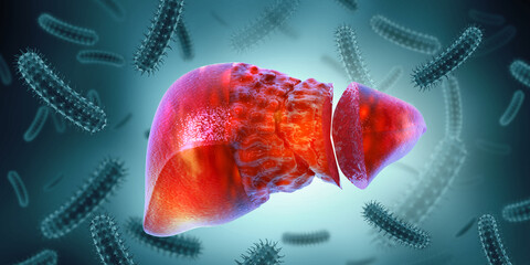 Wall Mural - Liver damage such as Fatty liver, Fibrosis, Cirrhosis, and Liver cancer. 3d illustration