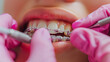 © Goncharuk film - Close-up of an orthodontist's hands adjusting braces on a patient's teeth. Suitable for dental, healthcare, and medical themes. Generated AI