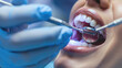 © redflower - Dentist Providing Fluoride Treatment to Teeth
