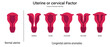 © Dee-sign - Female infertility vector. Comparison of normal uterine and congenital uterine anomalies. Uterine factor. Didelphys, Arcuate, Unicornuate, Bicornuate and Septate.