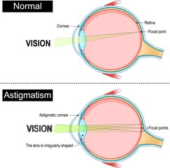 Astigmatism. Eye anatomy.