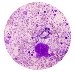 Canvas Print - Bone marrow study (BMS).Panmyelosis. Myeloproliferative disorder. Acute myeloid leukemia.