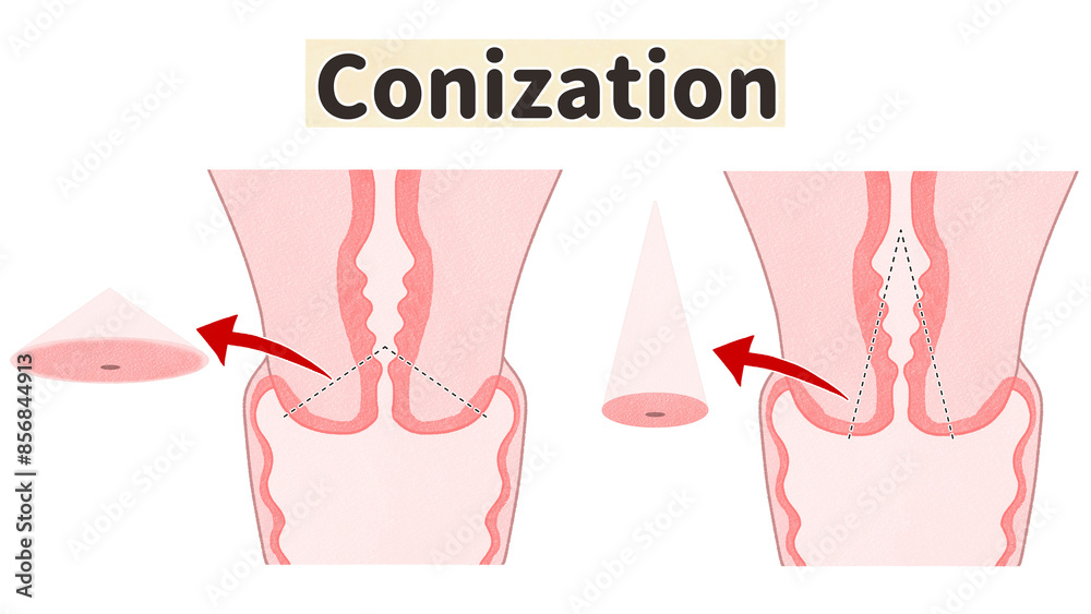 Cervical conization Medical diagram PNG Stock Illustration | Adobe Stock