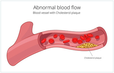 Wall Mural - Blood vessel and cholesterol plaque medical science educational PNG illustration