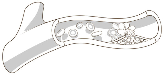 Wall Mural - Blood vessel and clot thrombus medical science educational PNG illustration
